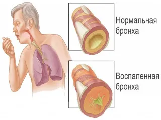 Cum bronșită Cum bronșită