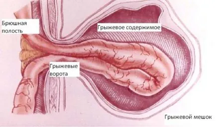 Efecte Hernia-l Efecte Hernia-l