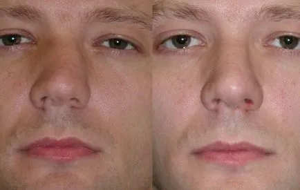 Corectarea septului nazal ca