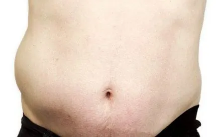 Efecte Hernia-l Efecte Hernia-l