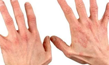 Preparate pentru tratamentul dermatitei