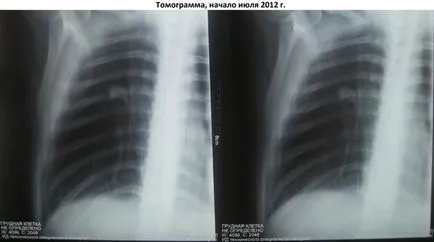 Ce este tuberculoma pulmonar
