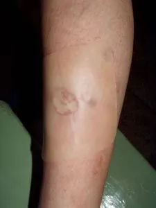 Terapia UHF care este