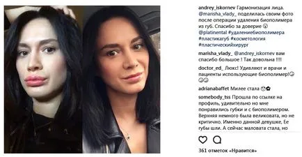 Buzele ca o rață