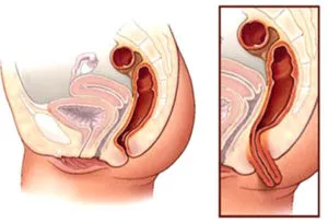 Mucusul din anus ea