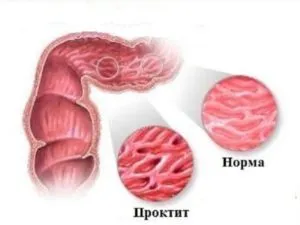 Mucusul din anus ea