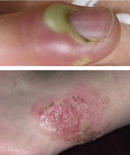 Impetigo este ceea ce este