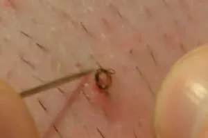 Care este parul pubian Care este parul pubian