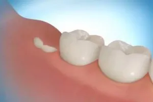 De ce cresc un dinte înțelepciune De ce cresc un dinte înțelepciune