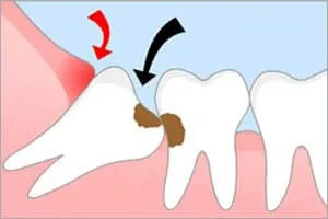 De ce cresc un dinte înțelepciune De ce cresc un dinte înțelepciune