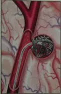 Anevrism cerebral - cauze, simptome si tratament (cap) Anevrism cerebral - cauze, simptome si tratament