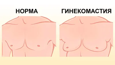 Simptomele ciroza alcoolica si semne, tratament și prognostic