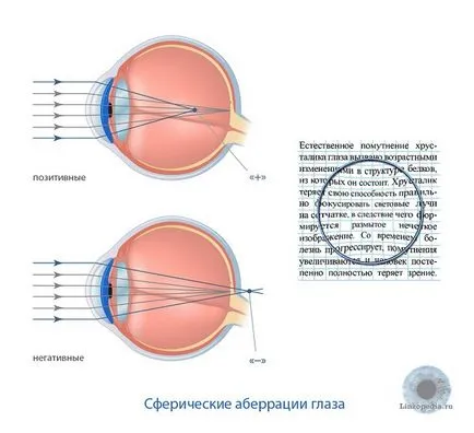 lentile asferice pentru ochi - descriere, caietul de sarcini, prețurile medii (sferice și lentile asferice) lentile asferice pentru ochi - descriere, caietul de sarcini, prețurile medii