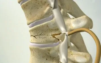 Durere la nivelul coloanei vertebrale între omoplați cauze, simptome, tratament si prevenire