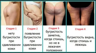 Cauzele celulitei, cum să scape de, prevenire, masaj (cauza) Cauzele celulitei, cum să scape de, masaj, prevenirea