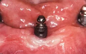 Implanturile sunt dinți periculoase, implanturi dentare de pericol
