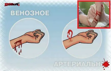 Riscul de sângerare - tratamentul hemoragiilor
