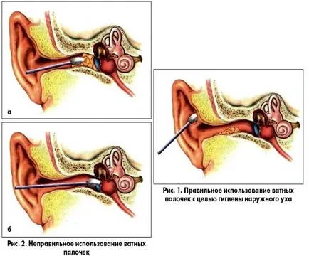 Cum pentru a curăța urechile - instrumentele și instrumentele de curățare corespunzătoare a urechilor (ureche) Cum pentru a curăța urechile - instrumentele și instrumentele pentru curățarea corespunzătoare a urechilor