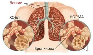 Ce este - bronhodilatatoare, lista de medicamente bronhodilatatoare, efectele lor și indicații