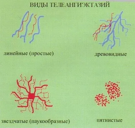 Care este plasa capilara pe picioare si modul de a elimina semnele și tratamentul