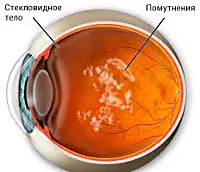 Floater - cauze, simptome, diagnostic și tratament