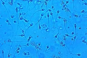 ochi floater remedii populare termoprelucrare pentru a scapa (ochi de tratament care plutește remedii populare pot fi vindecate globii oculari joc de sport de masaj) Distrugerea ochiului vitros remedii populare termoprelucrare pentru a scăpa