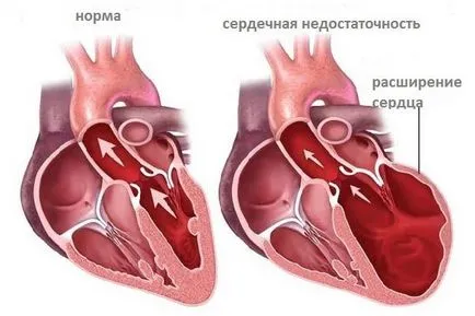Difuz cauze cardio, simptome, tratament