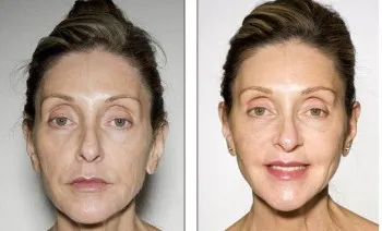 Facelift (lifting facial) tehnici, recenzii și caracteristici
