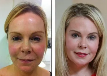 Facelift (lifting facial) tehnici, recenzii și caracteristici