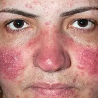 Herpes pe fata