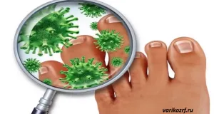 ciuperca unghiilor pe picioare (distrugerea plăcii de unghii) unghiile de la picioare fungus