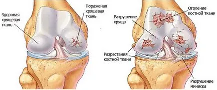 Osteoartrita genunchiului tratamentul bolilor articulare