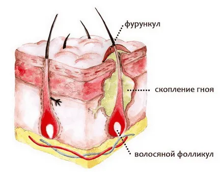 simptome Hidradenitis si tratament, cauze, cum să trateze ugerului tarfei la domiciliu (hidradenita) simptome Hidradenitis si tratament, cauze, cum să trateze ugerului tarfei la domiciliu