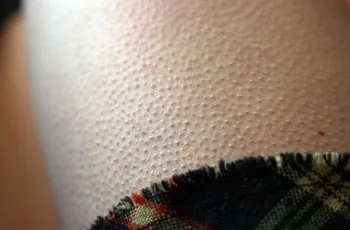 Goosebumps asupra simptomelor sale picioare si modalitati simple de a trata îngrijirea corpului (dur) Goosebumps asupra simptomelor sale picioare si modalitati simple de a trata îngrijirea corpului