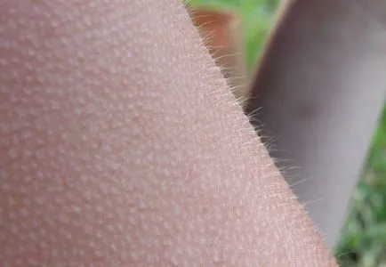 Goosebumps pe picioarele mele pentru a scapa de un cos (picioare) Goosebumps pe picioarele mele pentru a scăpa de pustulă
