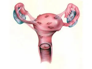 menopauza artificială și necesitatea de a efectua
