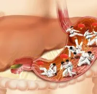 Ce este acidul în stomacul uman - acid clorhidric (unele) Ce este în acidul gastric uman - acid clorhidric