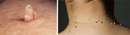 Cum sa scapi de negi pe gât la domiciliu și salon, o revizuire a remedii populare (rețete) Cum sa scapi de negi pe gât la domiciliu și salon, o revizuire a remedii populare