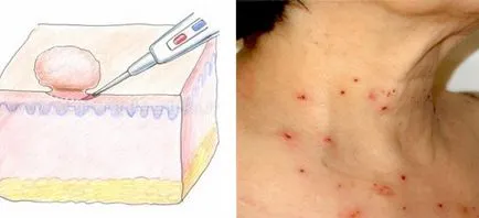 Cum sa scapi de negi pe gât la domiciliu și salon, o revizuire a remedii populare (acasă) Cum sa scapi de negi pe gât la domiciliu și salon, o revizuire a remedii populare