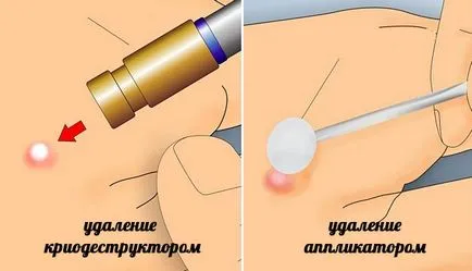 Cum sa scapi de negi pe gât la domiciliu și salon, o revizuire a remedii populare (acasă) Cum sa scapi de negi pe gât la domiciliu și salon, o revizuire a remedii populare