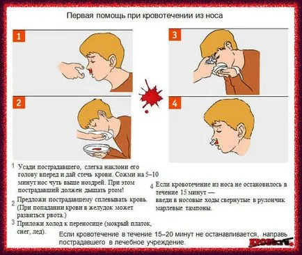 Cum de a opri sangerarea la un copil - Tratamentul hemoragiei (sânge) Cum de a opri sangerarea la un copil - Tratamentul sângerării