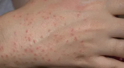Cum o alergie la produse chimice de uz casnic la om, opri alergie