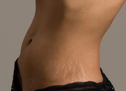 Cum de a elimina vergeturi pe abdomen, picioare și coapse la domiciliu