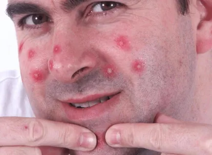 Cum de a accelera maturizarea acnee decât răspândirea, cum să se înțeleagă că acnee este copt
