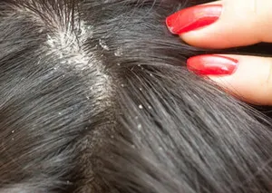 Cum de a vindeca dermatita seboreica pe cap cele mai bune mijloace