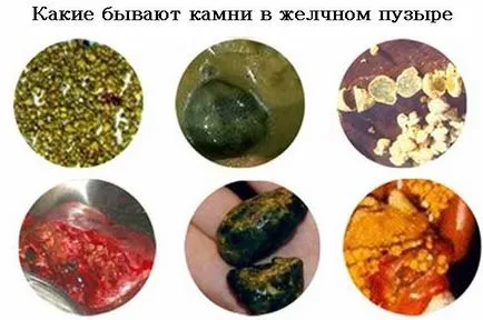 Pietrele din simptomele vezicii biliare, un tratament fără operație (balon) Pietrele din simptomele vezicii biliare, fara chirurgie