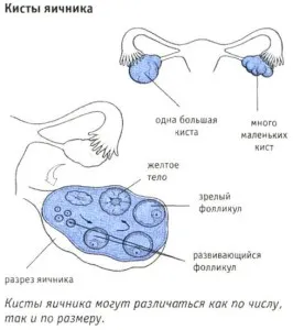 simptome chist ovarian la femei, semne de ruptură