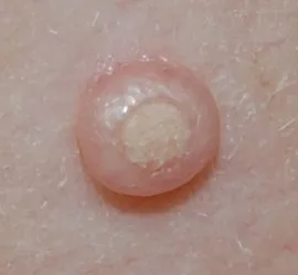 Fotografie: molluscum contagiosum, simptome, tratament la domiciliu, îndepărtarea cu laser