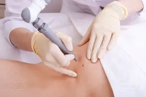 Molluscum contagiosum - tratamentul copiilor și adulților, precum și modalități de populare tradiționale