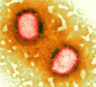 Fotografie: molluscum contagiosum, simptome, tratament la domiciliu, îndepărtarea cu laser
